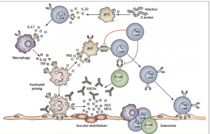 ANCA Associated Vasculitis